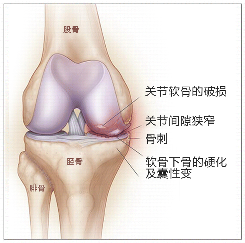 膝骨关节炎