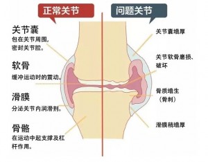 正常与异常膝关节示意图