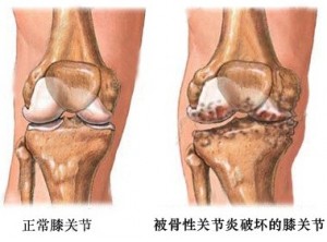 正常与异常膝关节