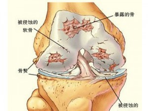 软骨移植1