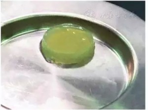 软骨移植2