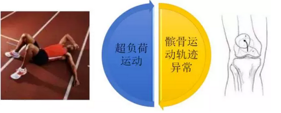 髌股疼痛图片3
