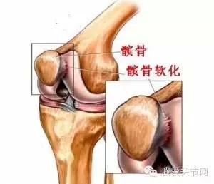 腿软2